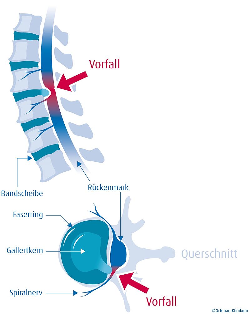 Physiotherapie nach Bandscheiben­operation sinnvoll